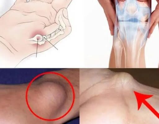 A cyst on the foot or wrist: What should you do?