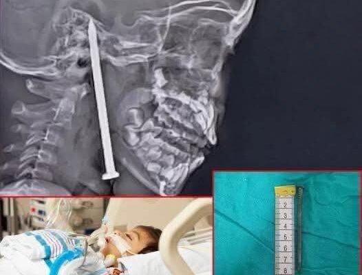 Year-Old Boy Survives After 3-Inch Nail Pierces His Brain In Shocking Playground Accident