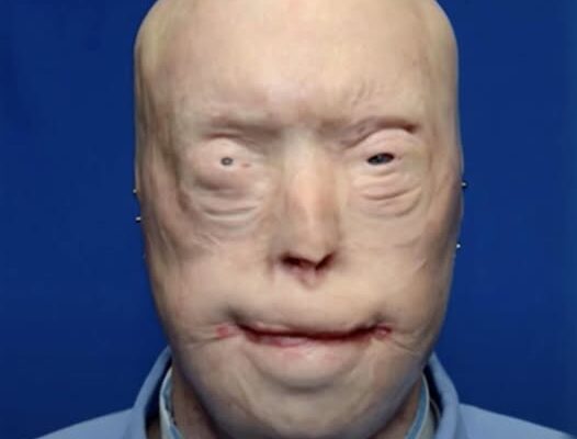 Firefighter Has Face Transplant After Third-Degree Burns & Survives Against All Odds – See Him Now, 7 Years Later
