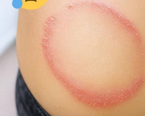 How to identify and cure skin fungus or ringworm.