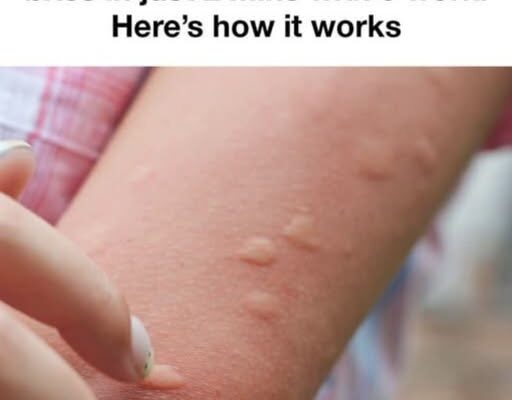 Doctors warn against viral hot spoon mosquito hack