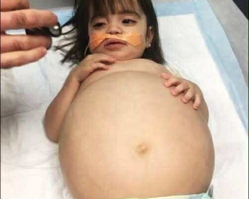 Little girl who looked 8 months’ pregnant because of deadly disease is saved thanks to dad’s kidney donation