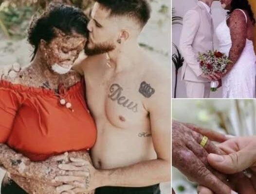 She was bullied by people who didn’t understand her condition – they called her rude names & said such as “monster” & ”zombie”. 😢😢 But her husband has the perfect response to haters