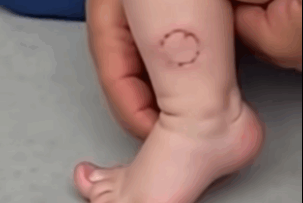 Doctor explains HEAT RASH (miliaria) in a baby | Causes, symptoms, treatment and prevention
