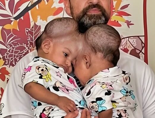 The Incredible Journey of Conjoined Twins Sharing Brain Tissue After a Risky Surgery!: See How They Look Now!