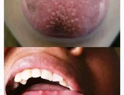 If you have pimples on your tongue, your body is warning you about something very important.