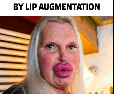 ST. They went too much in the pursuit of beauty: Girls who spoiled themselves drastically by lip augmentation