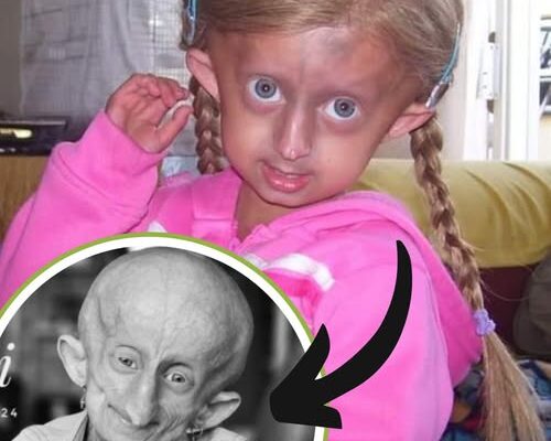 Teen Who Aged 8 Times Faster Than Normal Passes Away Just Before Christmas — Her Final Words Will Break Your Heart