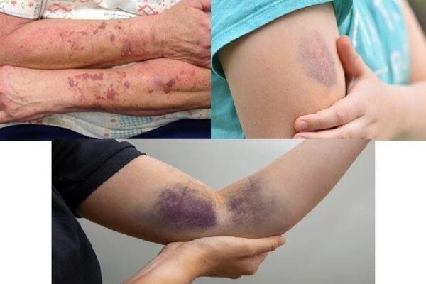 BE CAREFUL, if you get these bruises on your body, it means you have…