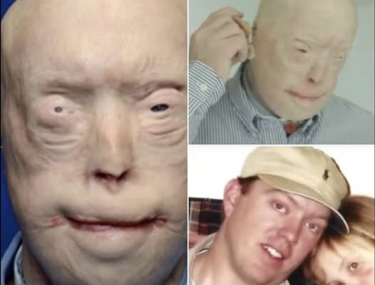 Firefighter suffers third-degree burns – this is him 7 years later