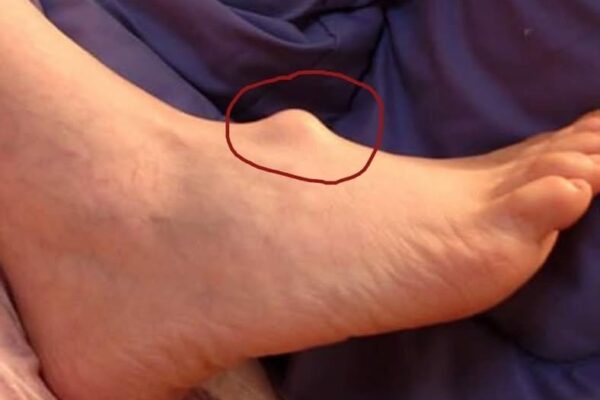 She noticed that she had a lump on her foot