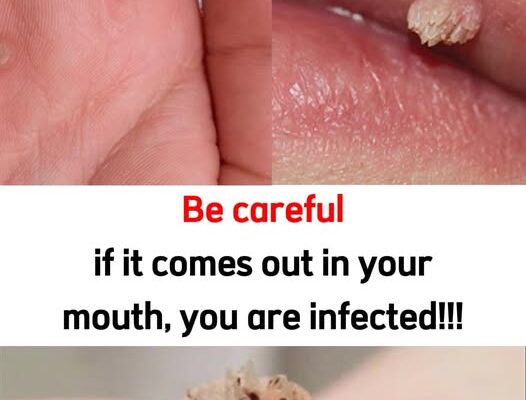 Be very careful if it comes out in your mouth, you are infected