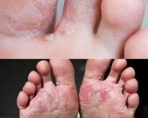 War:ning: If you have this on your feet, it may be a sign of hidden diabetes, stay al:ert