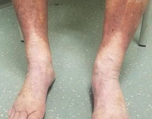 Signs on your FEET that indicate your veins…