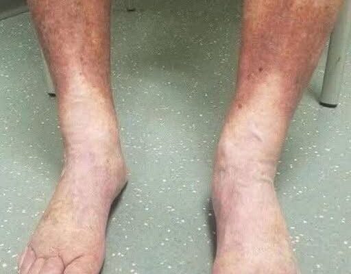 Signs on your FEET that indicate your veisn… See details in first comment