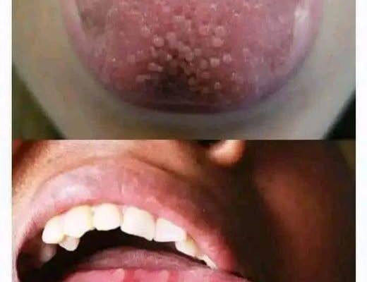 😱If you have pimples on your tongue, your body is warning you about something very important