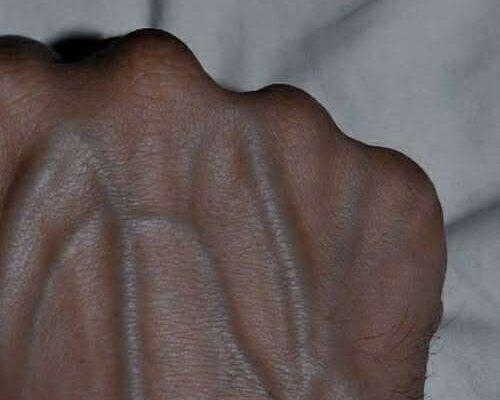 Visible Veins Explained: Normal Causes, Health Risks, and When to Worry