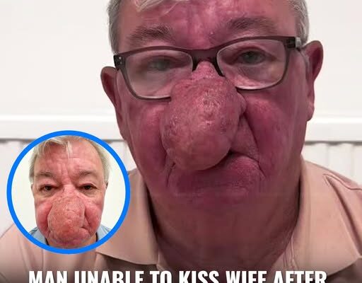 Man Unable To Kiss Wife After One Of The ‘Worst Cases’ Of Nose Growth Doctors Had Ever Seen