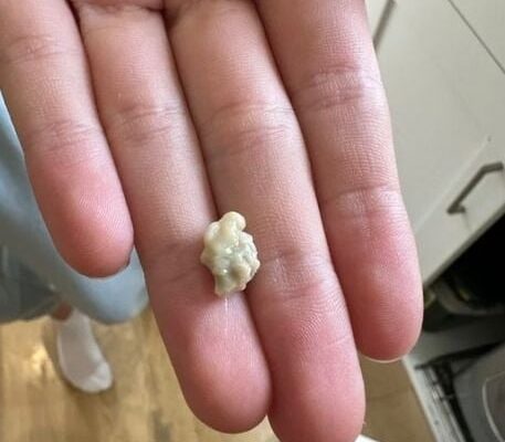Here’s What You Need to Know About Tonsil Stones