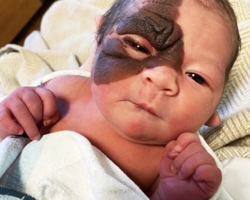 Mom wants daughter with rare birthmark to know she’s beautiful